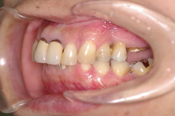 歯周病を伴った矯正治療前口内写真NO.17