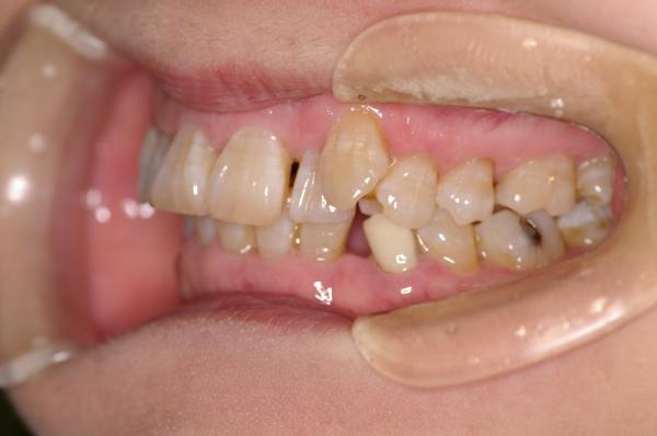 歯周病を伴った矯正治療前口内写真NO.18
