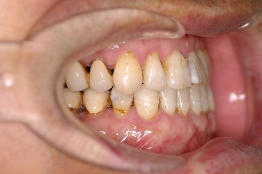 歯周病を伴った矯正治療後口内写真NO.3