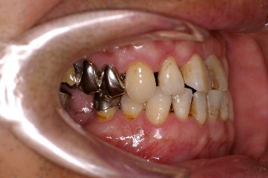 歯周病を伴った矯正治療前口内写真NO.3