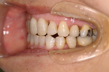 歯周病を伴った矯正治療後口内写真NO.6