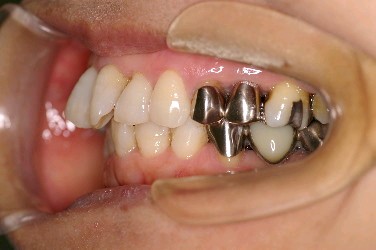 歯周病を伴った矯正治療前口内写真NO.6