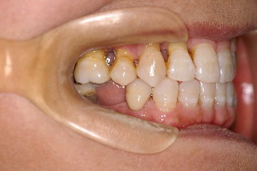 歯周病を伴った矯正治療後口内写真NO.7