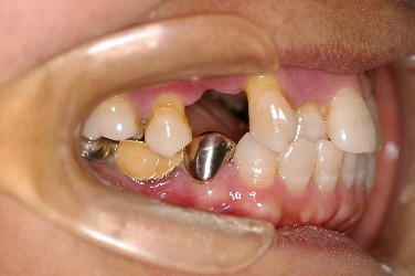 歯周病を伴った矯正治療前口内写真NO.7
