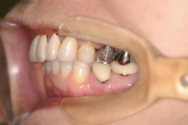 歯周病を伴った矯正治療前口内写真NO.8