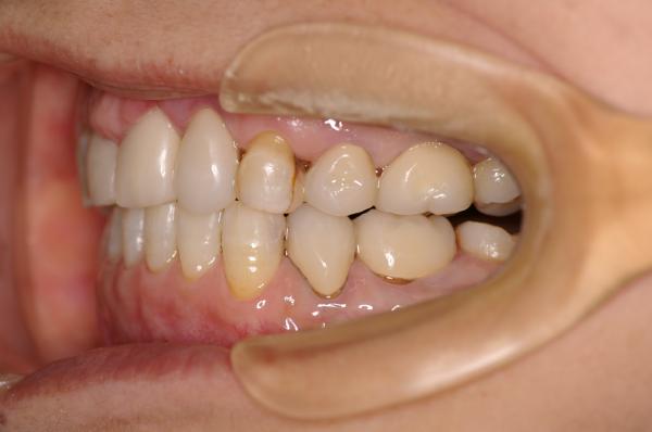 歯周病を伴った矯正治療後口内写真NO.8