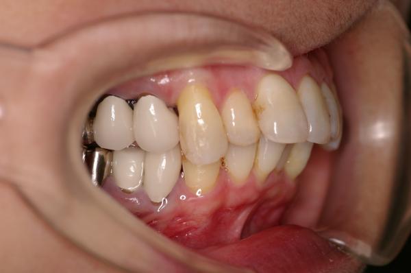 歯周病を伴った矯正治療前口内写真NO.9