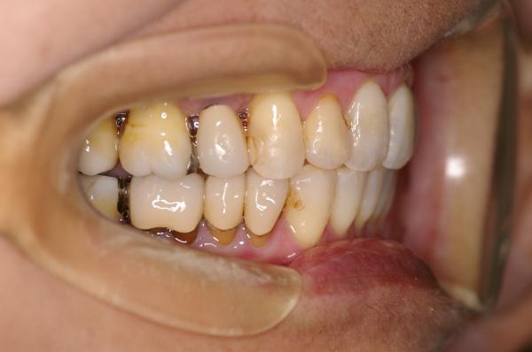 歯周病を伴った矯正治療後口内写真NO.9