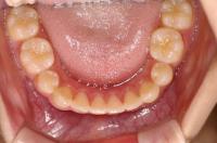 埋伏歯の矯正治療後口内写真NO.1