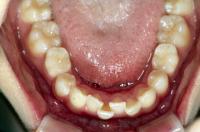 埋伏歯の矯正治療前口内写真NO.1
