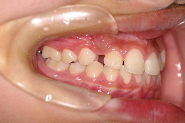 埋伏歯の矯正治療前口内写真NO.10