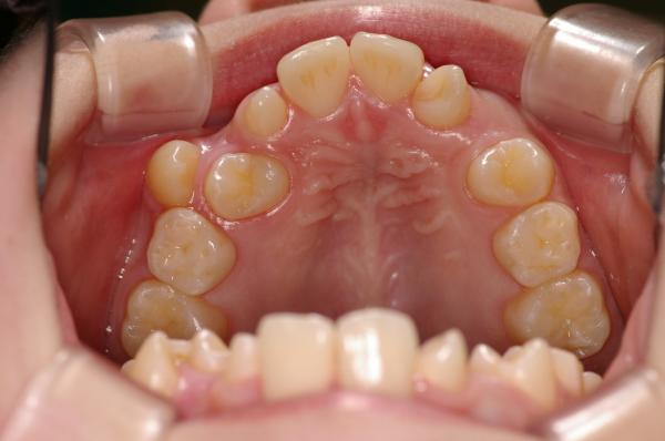 埋伏歯の矯正治療前口内写真NO.11