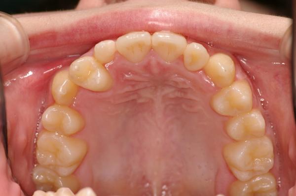 埋伏歯の矯正治療後口内写真NO.11