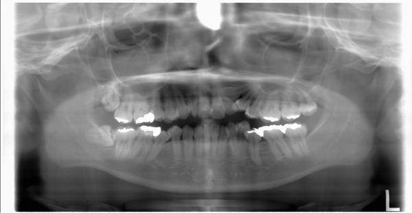 埋伏歯の矯正治療前口内写真NO.12