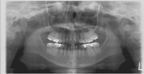 埋伏歯の矯正治療後口内写真NO.12