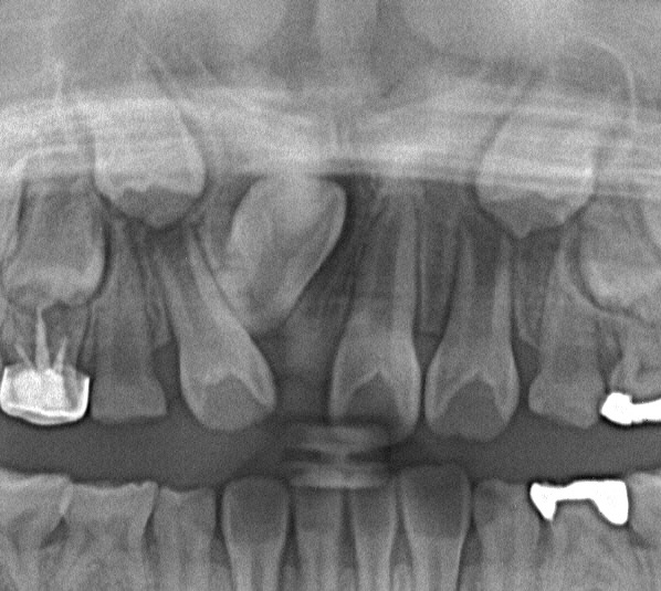 埋伏歯の矯正治療前口内写真NO.13