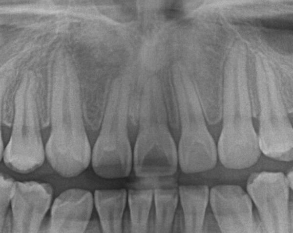 埋伏歯の矯正治療後口内写真NO.13