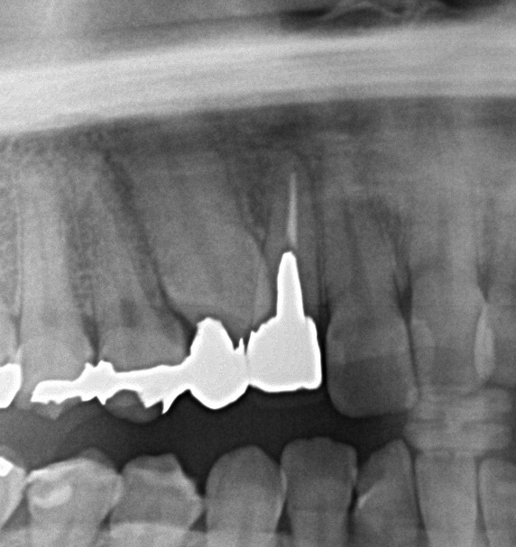 埋伏歯の矯正治療前口内写真NO.14