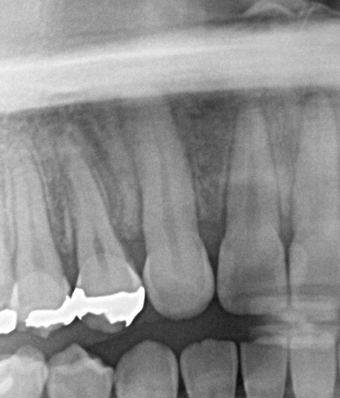 埋伏歯の矯正治療後口内写真NO.14