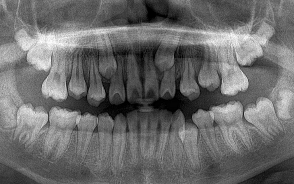 埋伏歯の矯正治療前口内写真NO.15