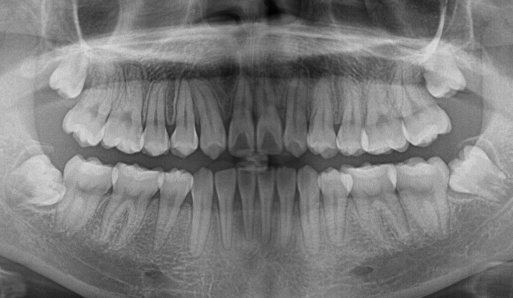 埋伏歯の矯正治療後口内写真NO.15