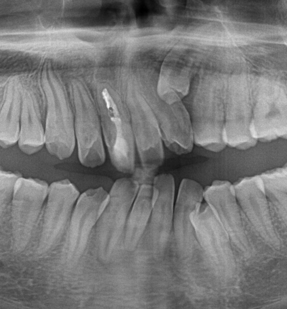 埋伏歯の矯正治療前口内写真NO.16