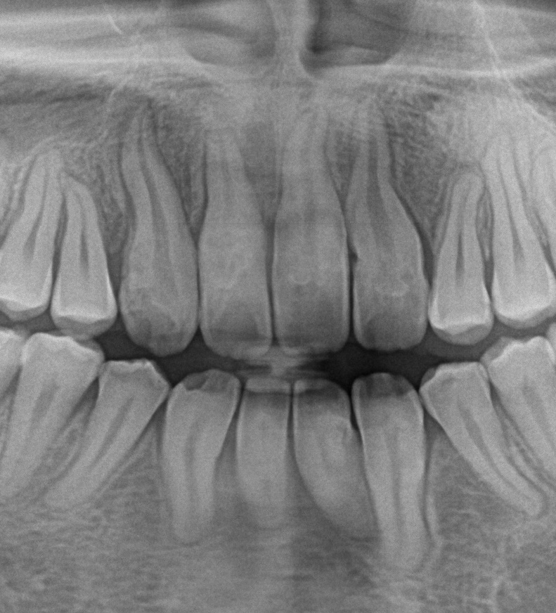 埋伏歯の矯正治療後口内写真NO.16
