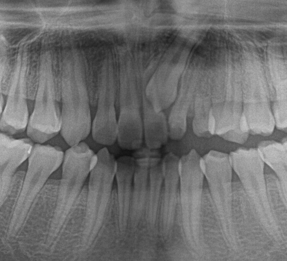 埋伏歯の矯正治療前口内写真NO.17