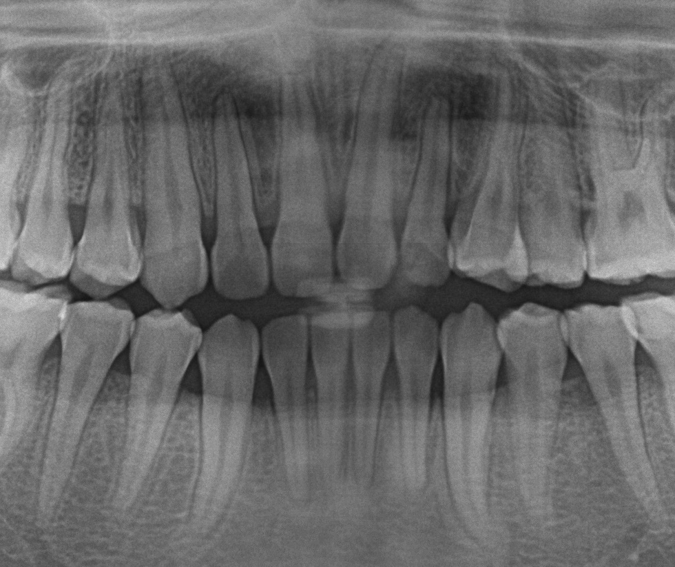 埋伏歯の矯正治療後口内写真NO.17