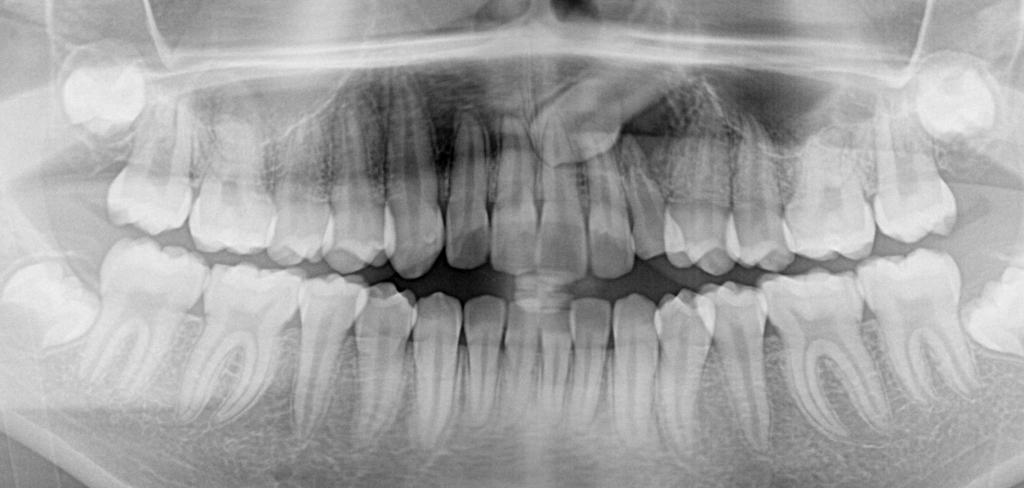 埋伏歯の矯正治療前口内写真NO.18