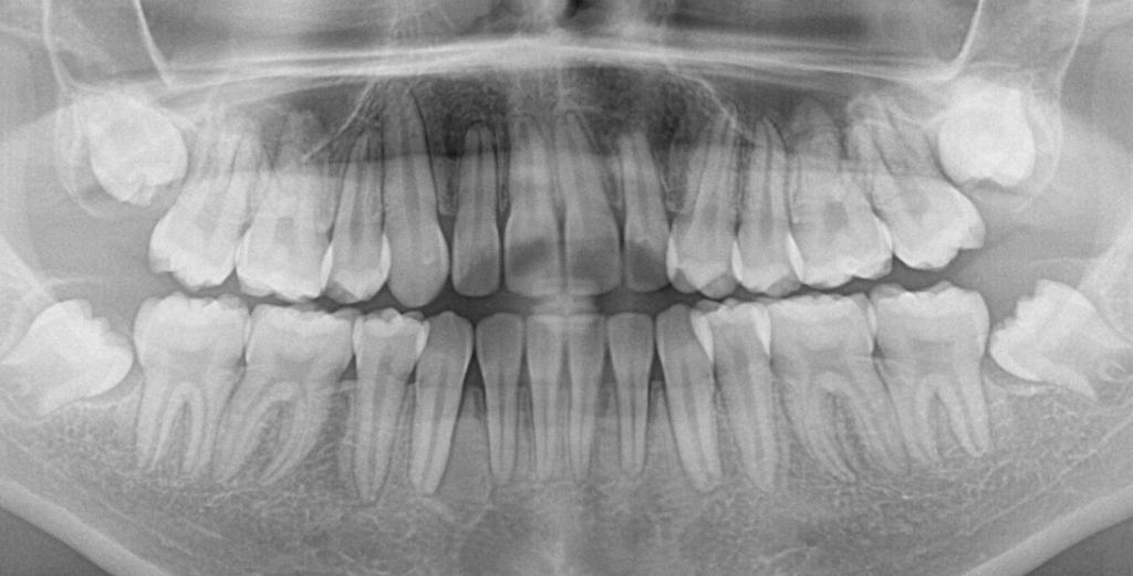 埋伏歯の矯正治療後口内写真NO.18