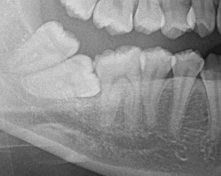 埋伏歯の矯正治療前口内写真NO.19
