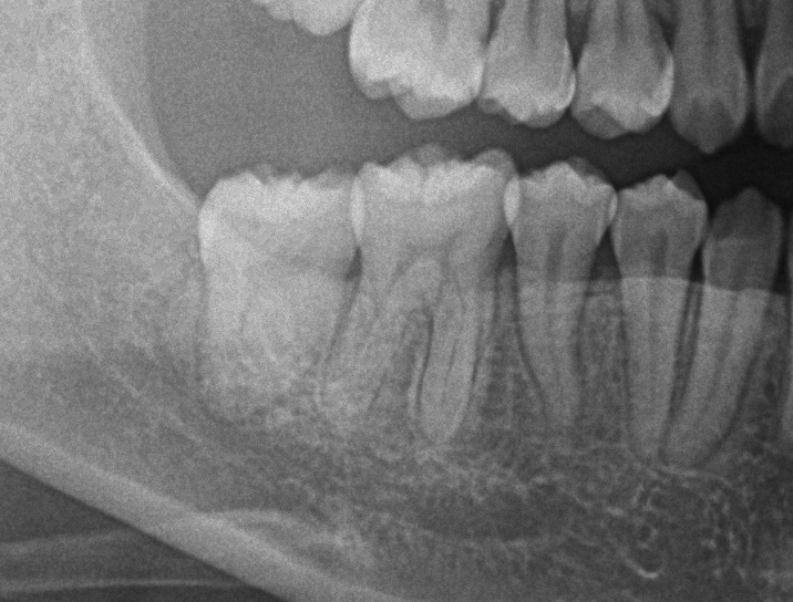 埋伏歯の矯正治療後口内写真NO.19