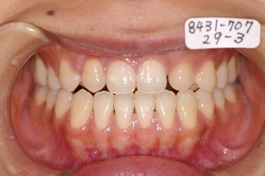 埋伏歯の矯正治療後口内写真NO.2