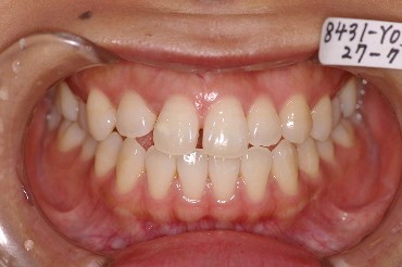 埋伏歯の矯正治療前口内写真NO.2