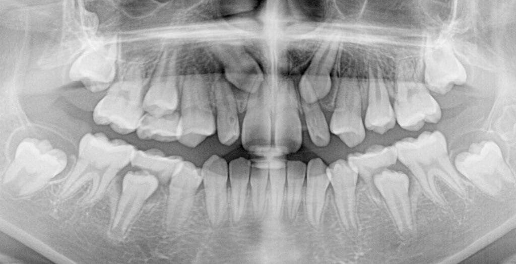埋伏歯の矯正治療前口内写真NO.20