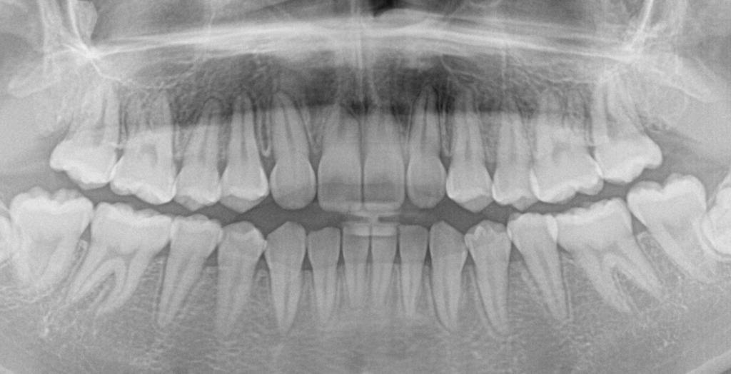 埋伏歯の矯正治療後口内写真NO.20