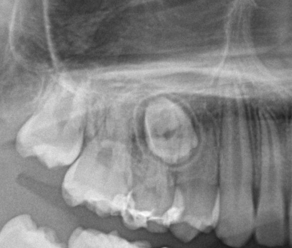 埋伏歯の矯正治療前口内写真NO.21