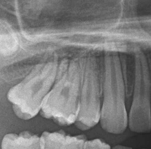 埋伏歯の矯正治療後口内写真NO.21
