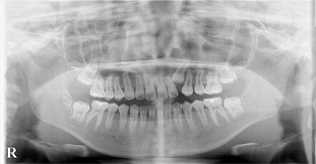 埋伏歯の矯正治療前口内写真NO.22