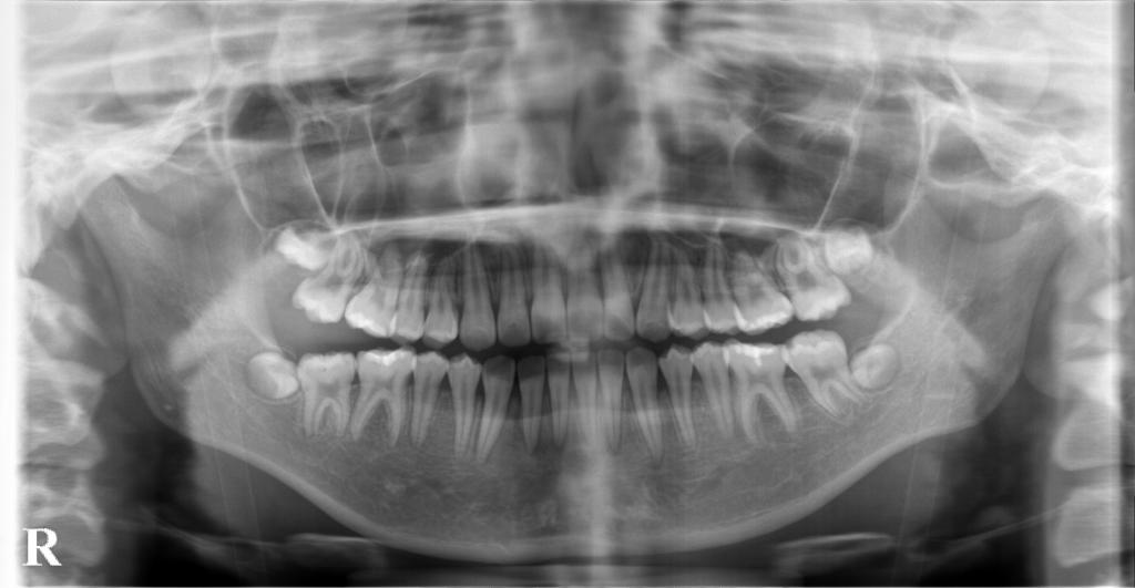 埋伏歯の矯正治療後口内写真NO.22