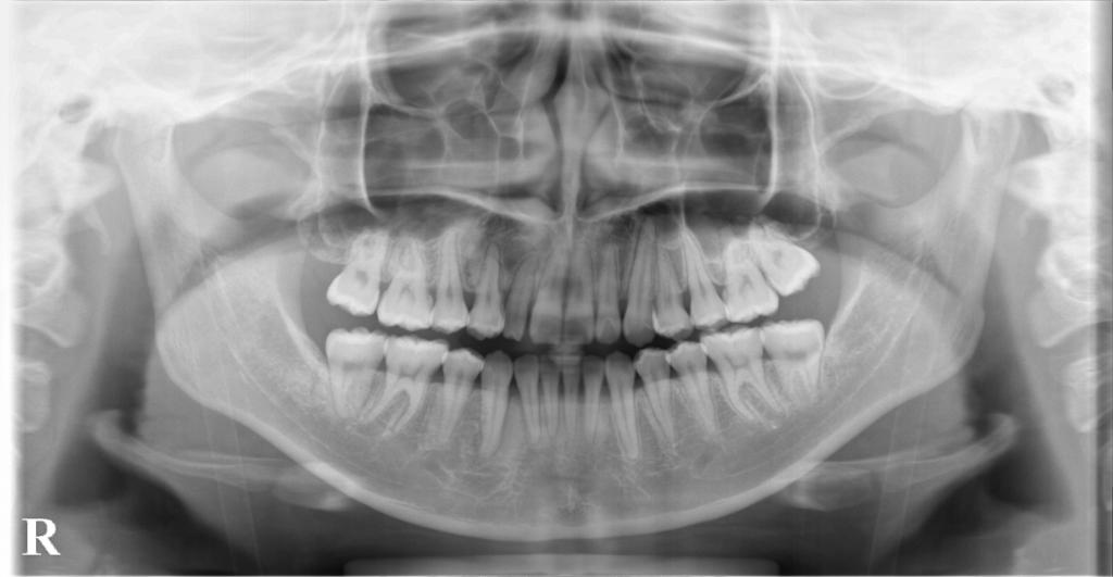 埋伏歯の矯正治療後口内写真NO.23