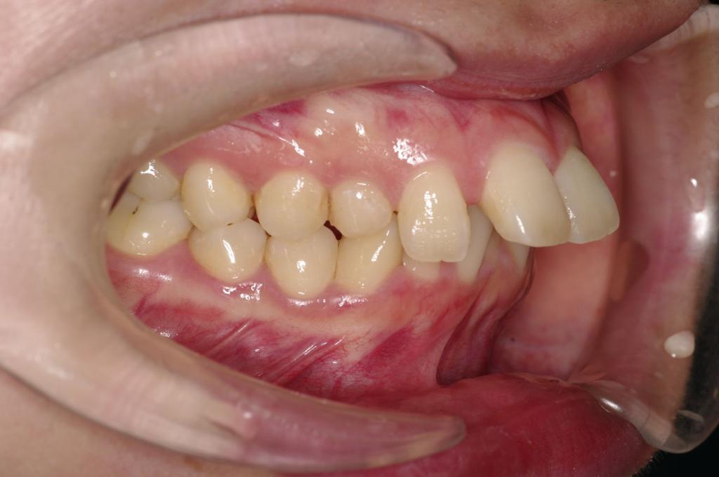 埋伏歯の矯正治療前口内写真NO.24