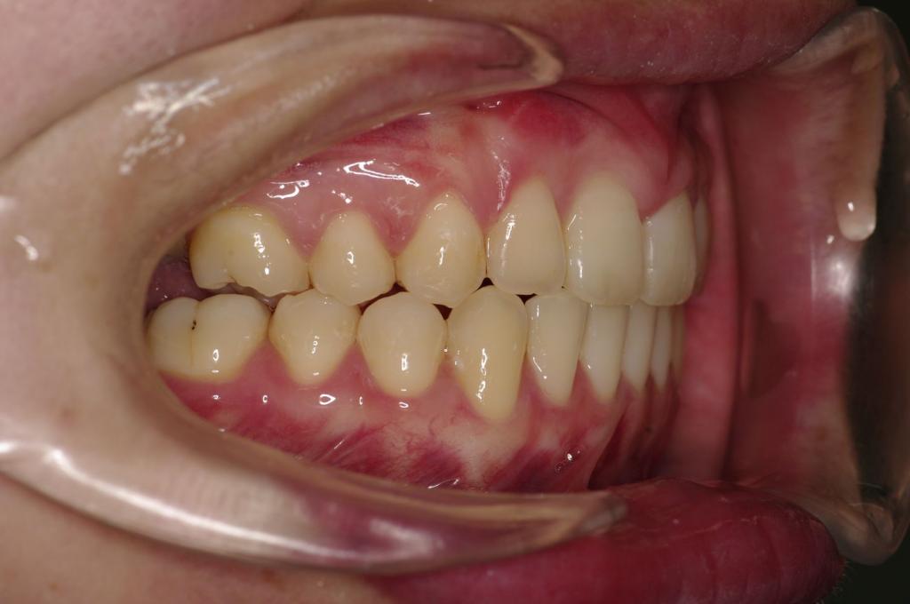 埋伏歯の矯正治療後口内写真NO.24