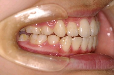 埋伏歯の矯正治療後口内写真NO.3