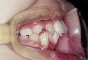 埋伏歯の矯正治療前口内写真NO.3