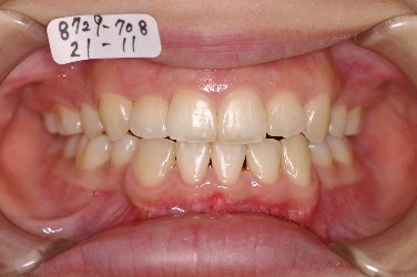 埋伏歯の矯正治療後口内写真NO.4