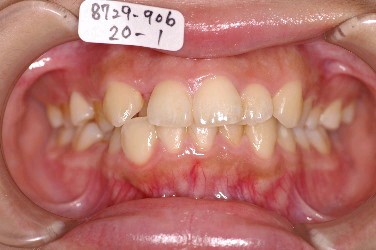 埋伏歯の矯正治療前口内写真NO.4