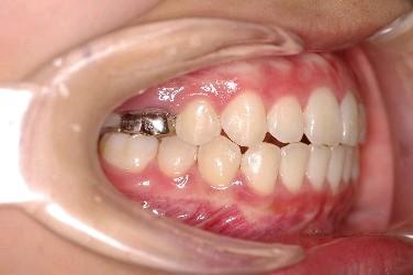 埋伏歯の矯正治療後口内写真NO.5
