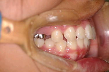 埋伏歯の矯正治療前口内写真NO.5